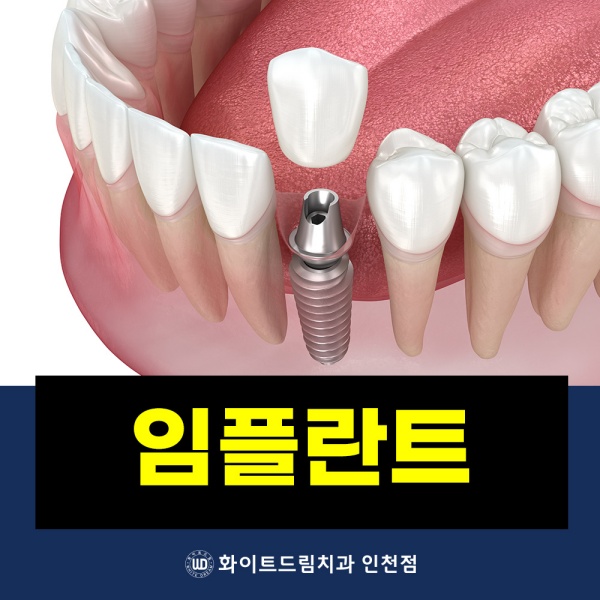 임플란트 진료도 화이트드림치과 인천점에서