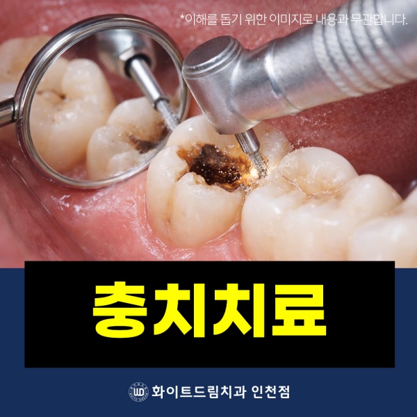 6. 충치치료.jpg