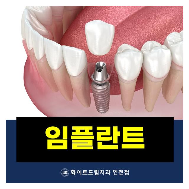 임플란트 진료는 화이트드림치과에서 받아보세요